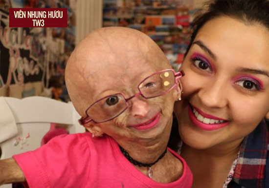 Hình ảnh cô bé Adalia Rose (bên trái) mắc căn bệnh Progeria - Bệnh lão hóa sớm 