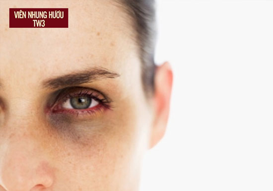 Đôi mắt xuất hiện quầng thâm - một trong những biểu hiện của việc da mắt bị lão hóa