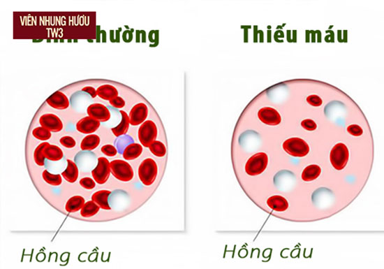 Tình trạng máu bình thường (bên trái) và thiếu máu (bên phải)