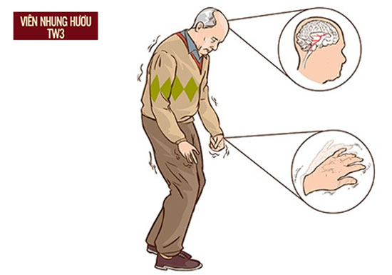 Người già bị bệnh Parkinson thường có biểu hiện đau đầu chóng mặt