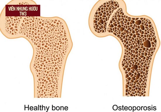 Mật độ Canxi suy giảm gây loãng xương khiến phụ nữ sau sinh bị đau lưng